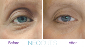 neocutis_ba