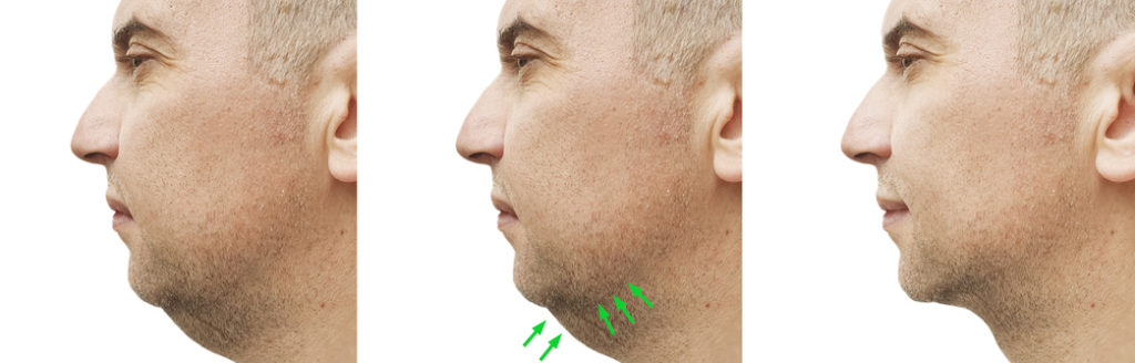 male that received a neck lift showing the progression from before and after treatment