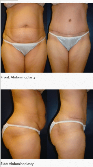 Abdominoplasty - Front & Side