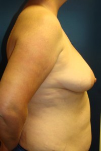 Mastopexy (Breast Lift) 38D to 38C - Conkright Aesthetics