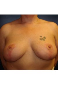 After Image of Mastopexy