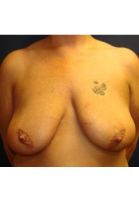 Before Image of Mastopexy