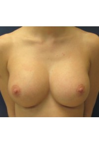 Silicone Breast Implants 32C to 32DD - Conkright Aesthetics