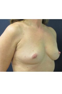 Silicone Breast Augmentation 36B to 36C - Conkright Aesthetics