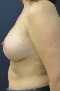 Silicone Breast Augmentation 36B to 36C - Conkright Aesthetics