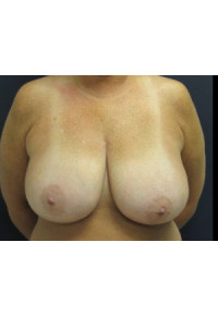Breast Reduction - 40DD to 40C - Conkright Aesthetics