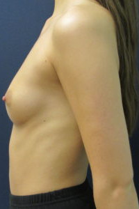 Silicone Breast Augmentation 32A to 32C - Conkright Aesthetics